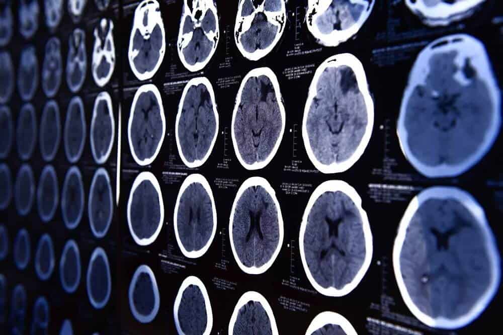 Neurology Symptoms, Diagnosis, and Treatments Precision Neurology